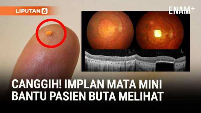 Implan Mata Mini Membantu Pasien Buta Kembali Melihat