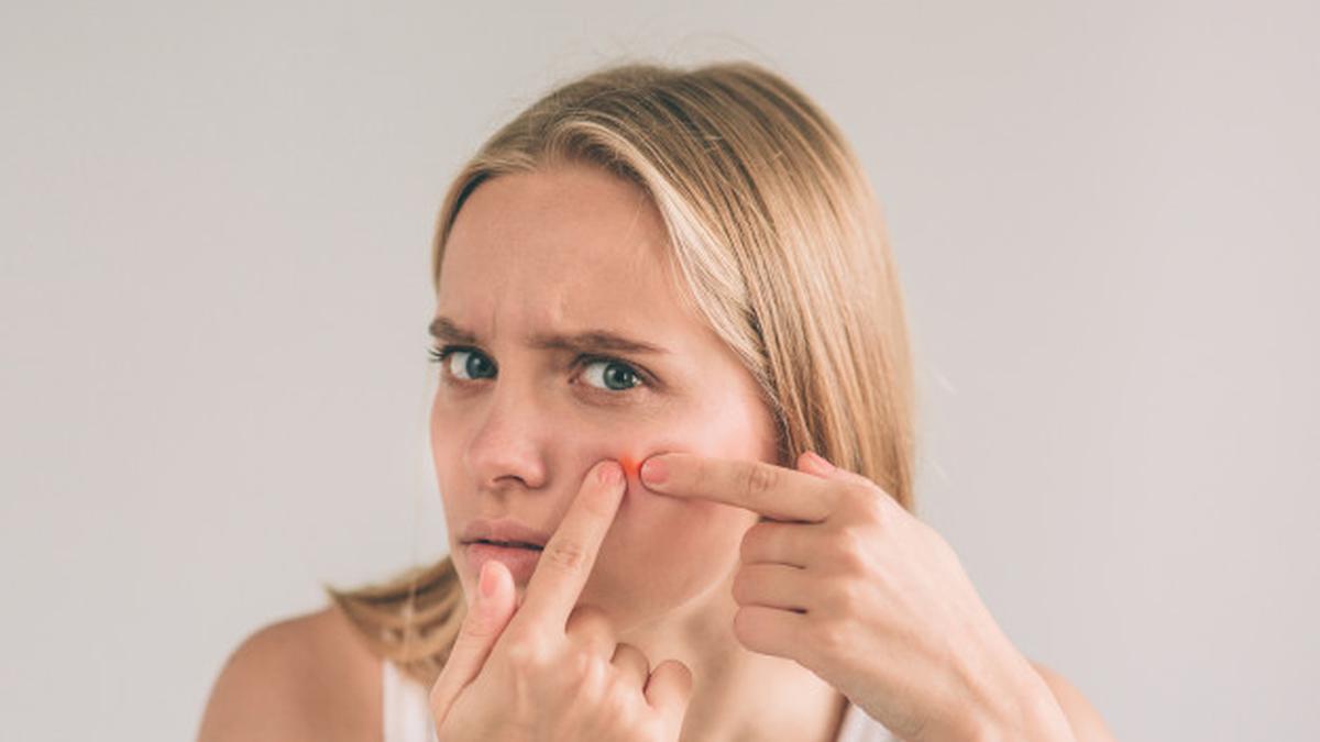 Kenali 13 Jenis Jerawat dan Cara Mengatasinya karena Tak Semua Jerawat Sama